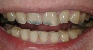Tooth Wear Damage, Tooth Wear, Martin Vale Dentistry