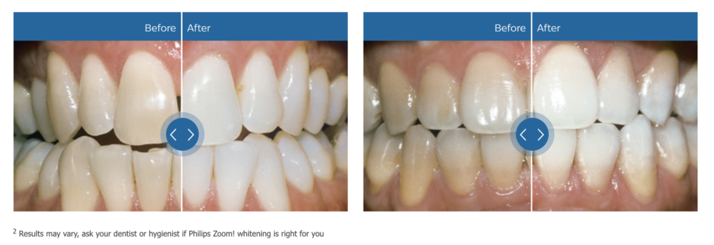 Teeth Whitening Bendigo, Teeth Whitening, Martin Vale Dentistry